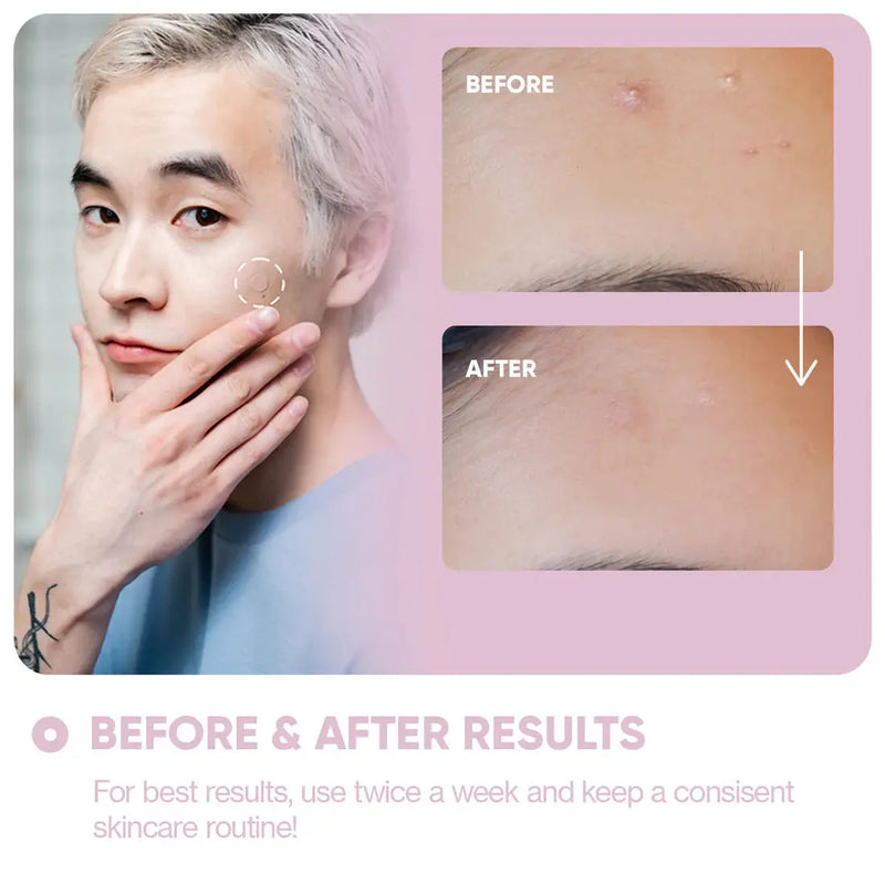 BreakoutAid Micro Needle Patches For Dark Spots