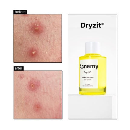 Acnemy Dryzit Dry Lotion