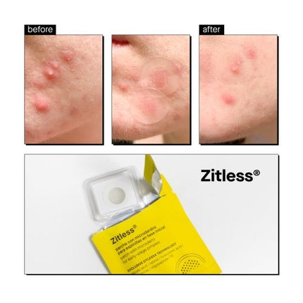 Acnemy Zitless Microdart Pimple Patches